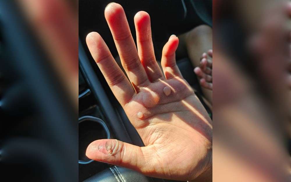 After being made to perform bear crawls on the track in the sweltering heat, several girls on the majorette team at Warren Central High School in Indianapolis,United States, sustained severe blisters and burns.