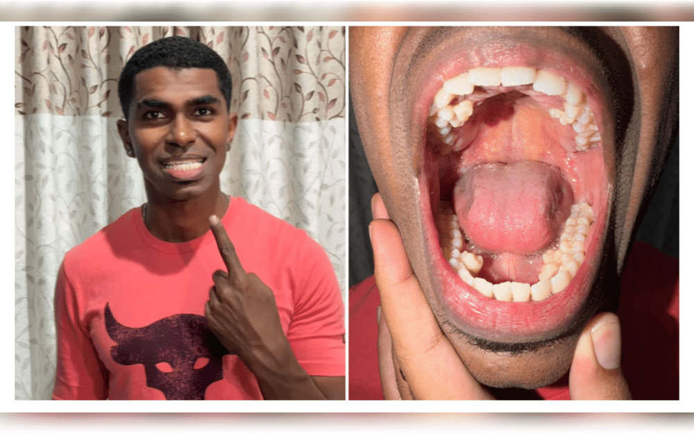 Malaysian Prathab Muniandy has ten more teeth than the typical human. This indicates that he has the most teeth in a person's mouth (male) with a total of 42.